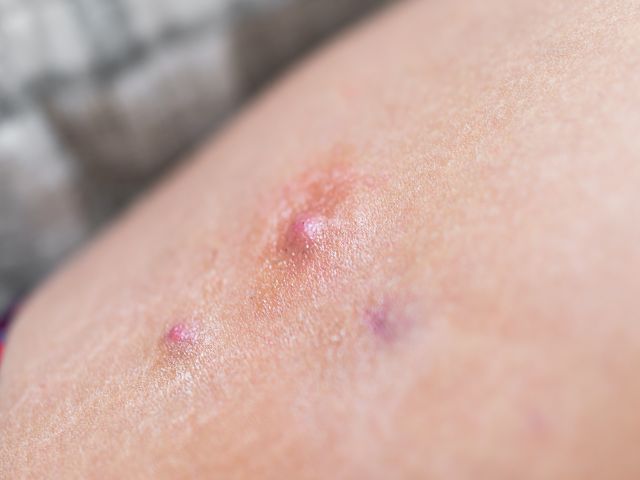 Makro-Nahaufnahme eines roten, geschwollenen Furunkels auf der Beinhaut einer Frau, die eine Erkrankung namens Hidradenitis suppurativa zeigt