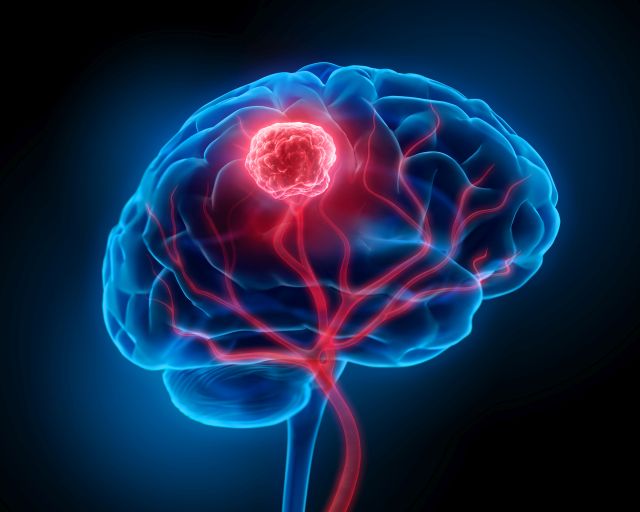 Hirntumor isoliert