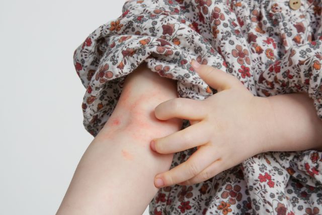 Kleinkind leidet an atopischer Dermatitis, Nahaufnahme. Rote und juckende Haut. Ekzem am Arm des Kindes.