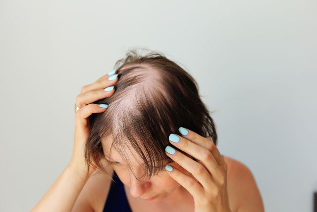 Kahle Stellen der totalen Alopezie einer Frau