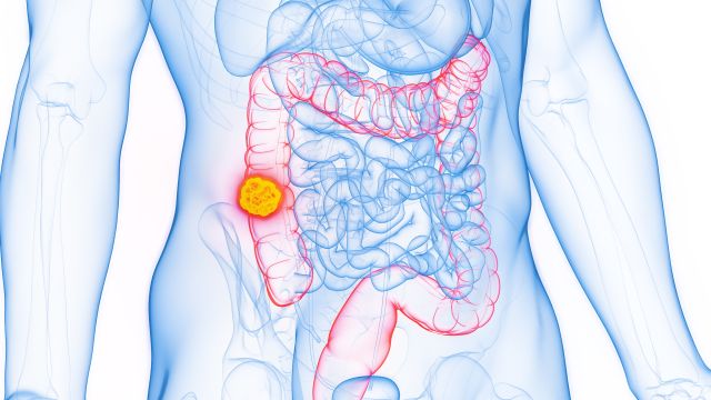 3D-gerenderte medizinische Illustration der männlichen Anatomie – Dickdarmkrebs; aufsteigender Dickdarm. Einfacher weißer Hintergrund.
