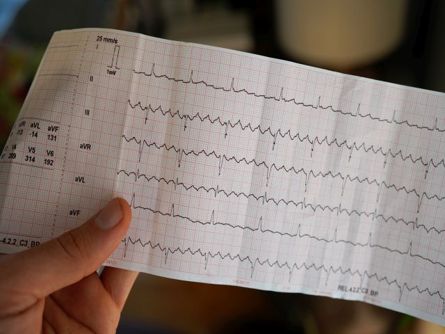 Hand hält ein echtes Elektrokardiogramm mit Vorhofflattern.