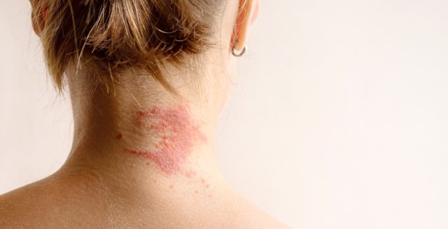 Manifestation einer atopischen Dermatitis als roter juckender Fleck am Hals einer Frau, Nahaufnahme, Rückansicht, Kopierraum. Dermatologie, Allergie, Juckreiz, rote Flecken oder Ausschlag auf der Haut