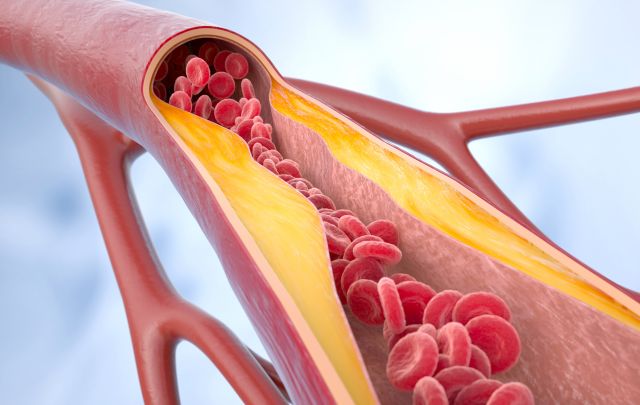 Illustration einer verengten Arterie durch Plaque-Ablagerungen, Fokus auf Lipidstoffwechsel und kardiovaskuläre Risiken