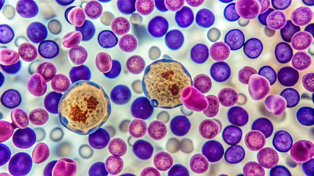 Mikroskopische Ansicht abnormaler Knochenmarkszellen mit unreifen Blasten, Kernanomalien und dysplastischen Merkmalen, die für das myelodysplastische Syndrom, eine Blutkrebserkrankung, charakteristisch sind