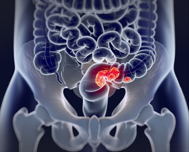 3D-Illustration des menschlichen Dickdarms mit bunt hervorgehobenem Tumor.