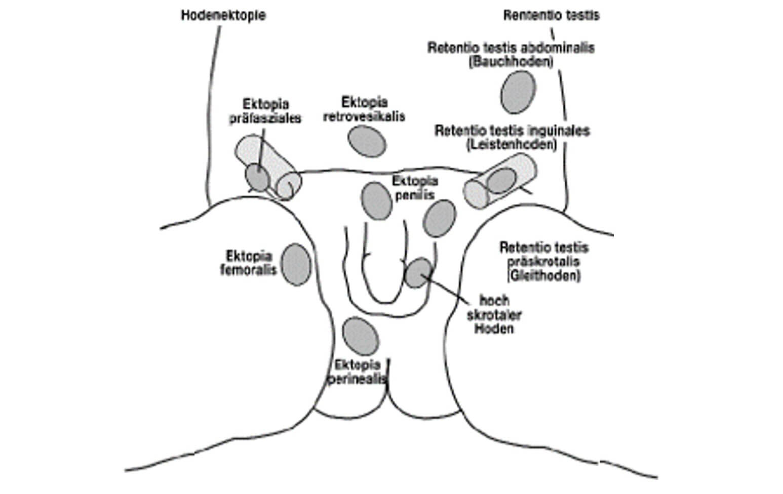 Maldeszensus testis