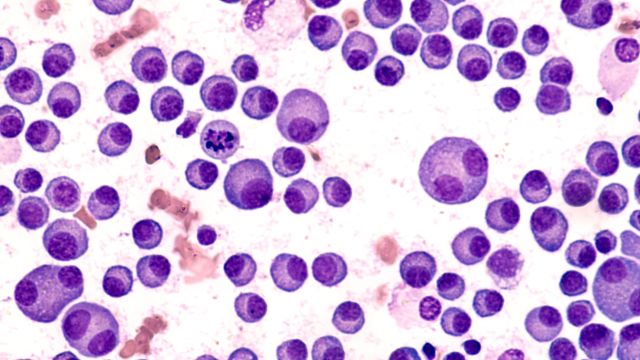 Knochenmarksausstrich des Multiplen Myeloms