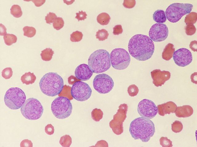 Blutzellen eines AML-Patienten unter dem Mikroskop