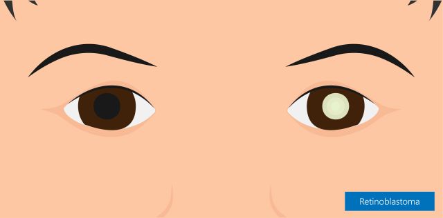 Retinoblastom
