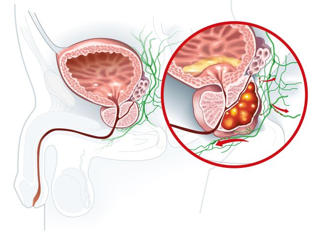 Anatomische Darstellung der Prostata mit vergrößertem Bereich, der eine Entzündung und umliegende Lymphknoten zeig