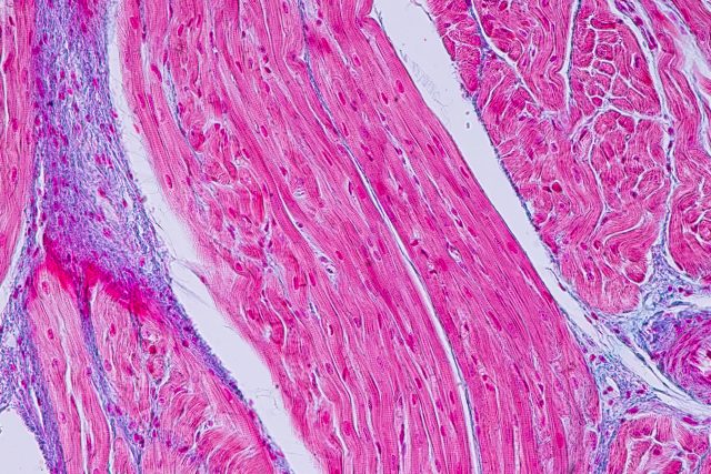 Mikroskopische Aufnahme von Herzmuskelgewebe mit Fokus auf Amyloidablagerungen, symbolisiert die Diagnostik der ATTR-Amyloidose mit Kardiomyopathie.