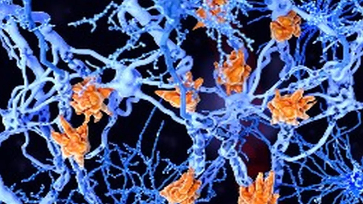 Ablagerungen der Multiple Sklerose, orange dargestellt in einem blauen Neuronennetz.