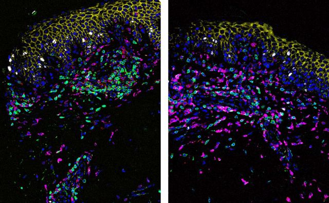 Das Bild zeigt Hautschnitte mit Fluoreszenzfärbung eines Studienpatienten vor und nach DMF-Therapie.
