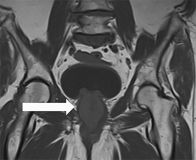 Abb. 2: MRT (coronar) des Beckens 01/2022 mit ausgedehnter, zirkulär infiltrierendem Urethra-Tumor auf gesamter Länge mit Blasenhals-Infiltration.