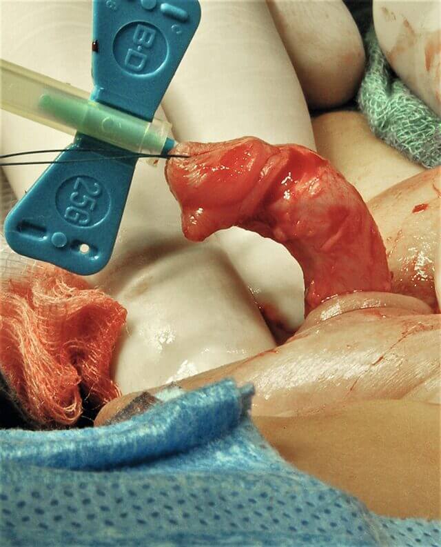 Distale Hypospadie
