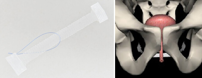 Needleless