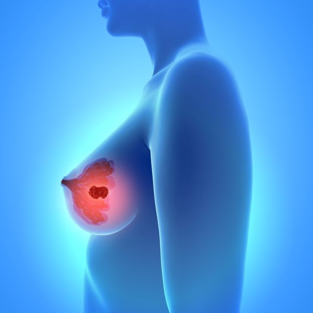 3D-Darstellung einer weiblichen Brust mit hervorgehobener Tumorregion, symbolisiert durch eine rote Markierung