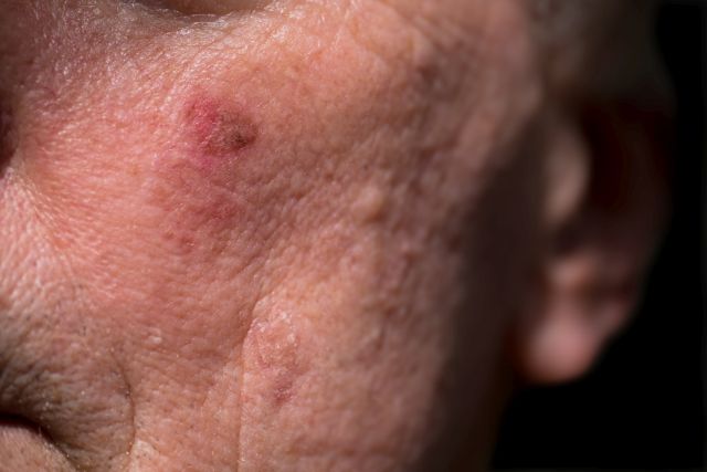 Rote, krustige Läsionen einer aktinischen Keratose oder Sonnenflecken auf sonnengeschädigter Haut auf der Wange unter dem linken Auge im Gesicht eines Mannes. Dies kann mit Kryochirurgie oder Salben behandelt werden