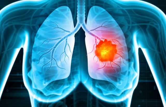 Röntgenbild der menschlichen Lunge mit hervorgehobenem Tumor im rechten Lungenflügel