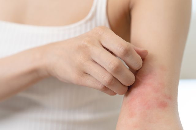 Empfindliche Haut allergisches Konzept, Frau Juckreiz auf ihrem Arm