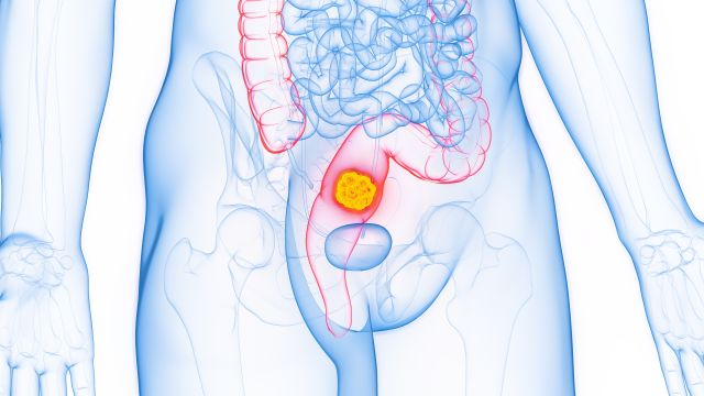 Medizinische Illustration eines Tumors im unteren Darmbereich, hervorgehoben in Gelb, mit Fokus auf die Anatomie des Verdauungssystems.