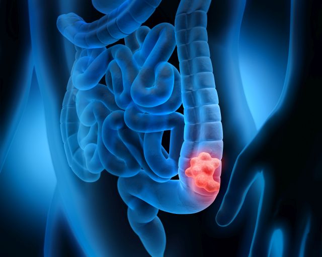 Darmpolyp