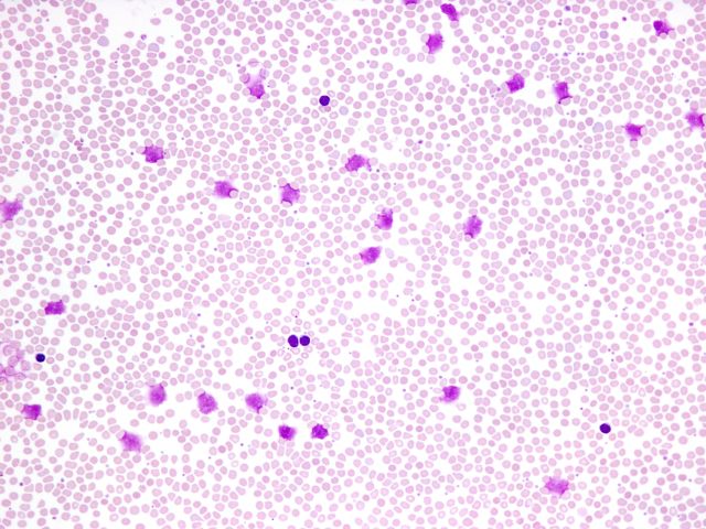 Blutausstrich. Chronische lymphatische Leukämie