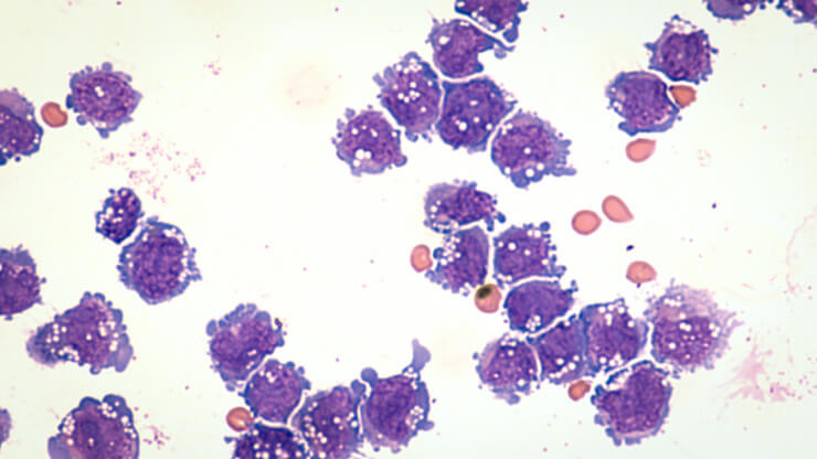 Diffuses großzelliges B-Zell Lymphom (Mikroskopische Aufnahme)