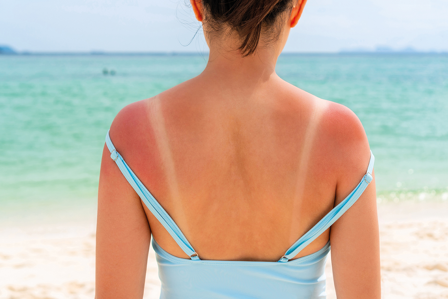 Mädchen mit Sonnenbrand auf dem Rücken