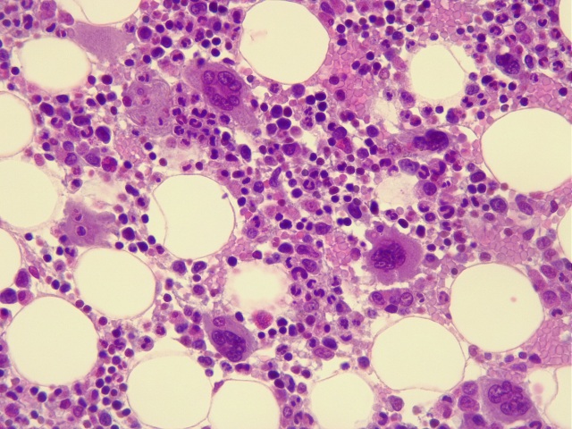 Mikroskopische Aufnahme von Knochenmarkzellen, passend zur BPDCN-Therapie mit Pivekimab Sunirin.