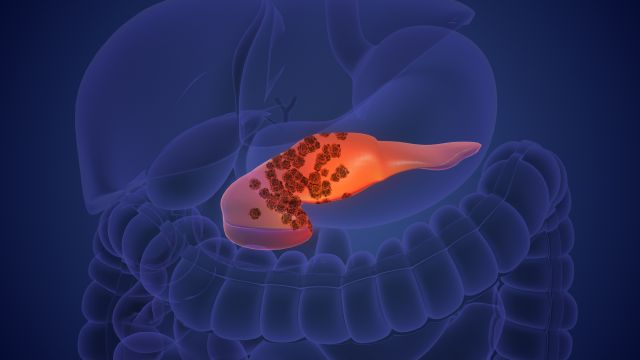 Illustration eines Pankreaskarzinoms mit Tumorzellen, passend zur CAR-T-Zelltherapie und ihrer Zielstruktur CD318.