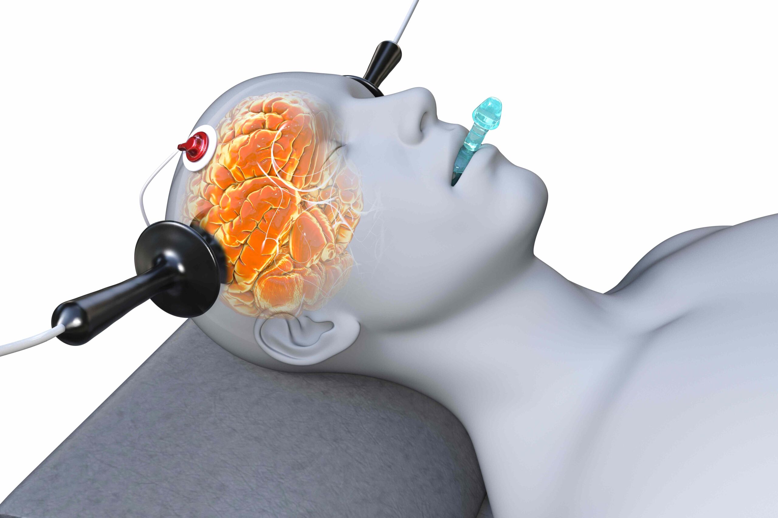 Elektrokonvulsionstherapie