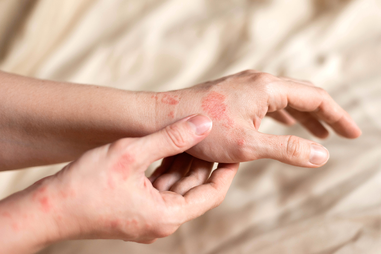 Nahaufnahme einer Hand mit roten Hautirritationen, die auf Ekzeme oder Neurodermitis hinweisen.