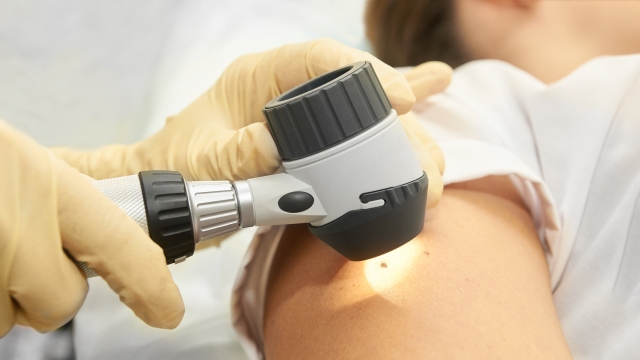 Dermatoskop-Untersuchung eines Muttermals zur Hautkrebs-Diagnose