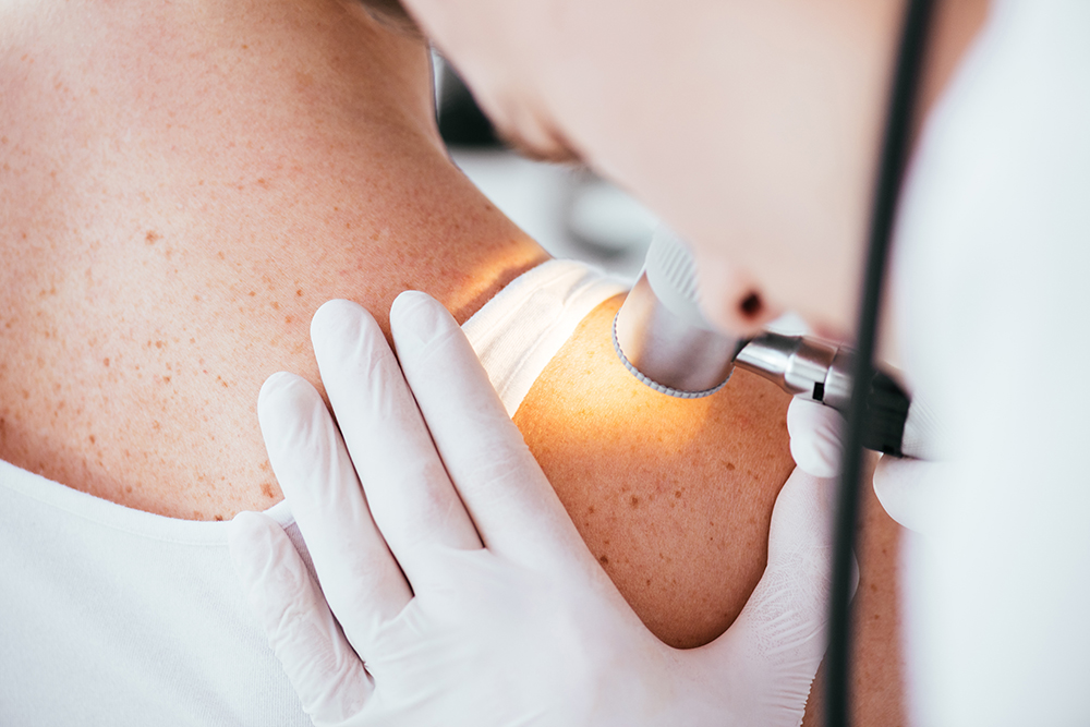 Dermatologe untersucht die Haut einer Patientin mit einem Dermatoskop während eines Hautkrebs-Screenings.