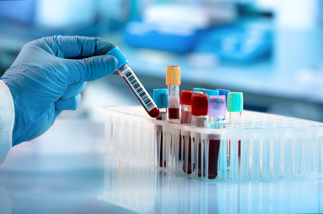 Blutproben im Labor zur Analyse von HbA1c-Werten für Brustkrebsprognosen