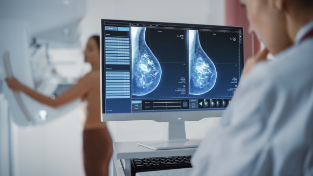 Bild eines Monitors mit Mammographie-Aufnahmen, die zur Brustkrebsfrüherkennung analysiert werden.