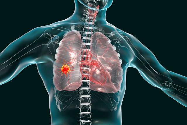 Illustration eines menschlichen Brustkorbs mit Fokus auf einem Tumor in der Lunge.