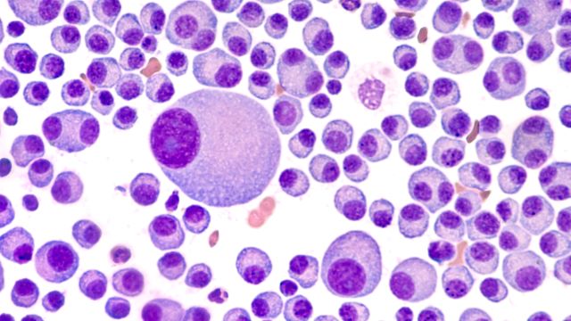 Zytologie des Knochenmarkaspirats beim Multiplen Myelom
