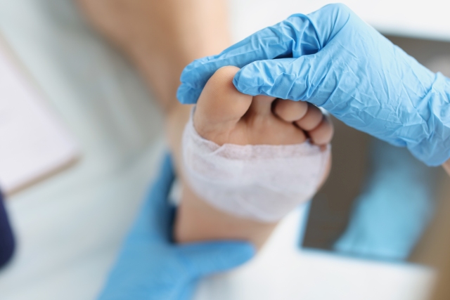 Nahaufnahme eines medizinischen Verbandwechsels an einem Fuß, durchgeführt von einer Person mit blauen Handschuhen.
