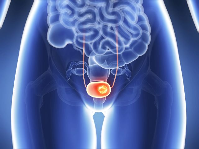 Ein wichtiger Fortschritt beim Gesamtüberleben sieht der GBA für die Wirkstoff-Kombination Pembrolizumab und Enfortumab Vedotin in der Therapie des Urothelkarzinoms. (Symbolbild © Sebastian Kaulitzki – stock.adobe.com)