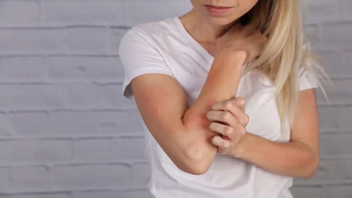 Foto von Frau, die sich am Arm kratzt, mit roten Stellen am Arm.