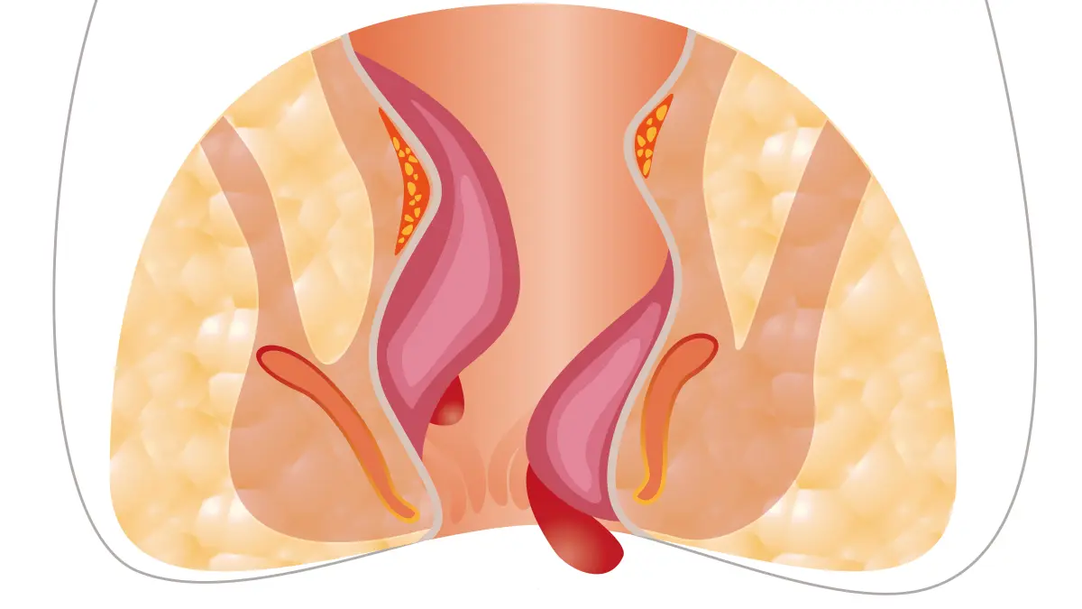 Illustration von Hämorrhoiden im Rektum, mit entzündeter vaskulärer Struktur und Blut.