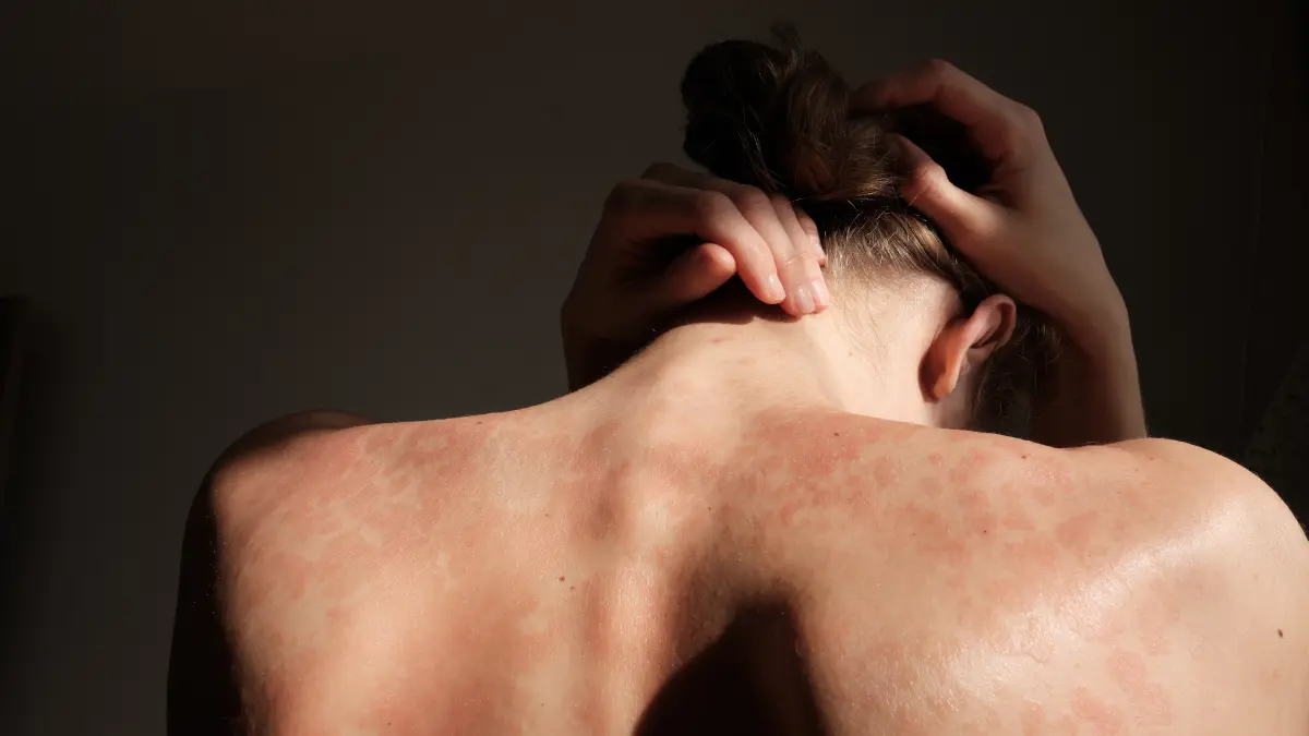 Rötungen und Hautirritationen auf dem Rücken einer Person, die dermatologische Erkrankungen und Hautpflege symbolisieren.
