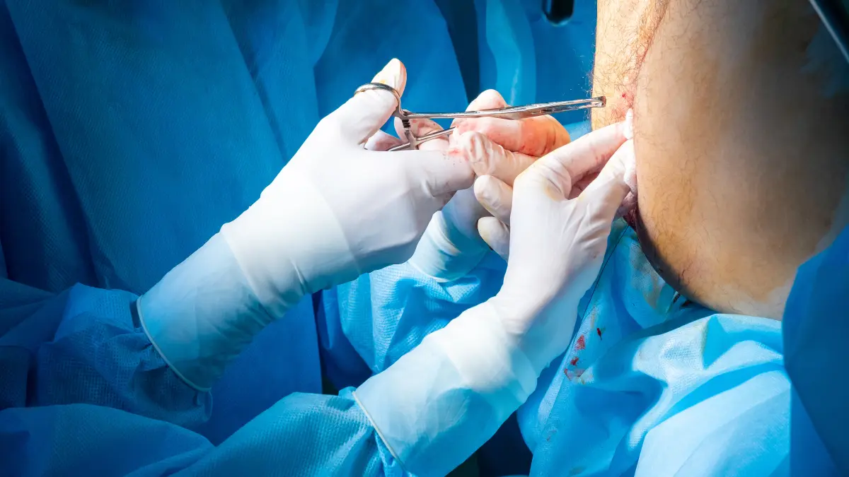 Chirurgen führen mit sterilen Handschuhen und speziellen Instrumenten eine koloproktologische Operation am Anus durch.