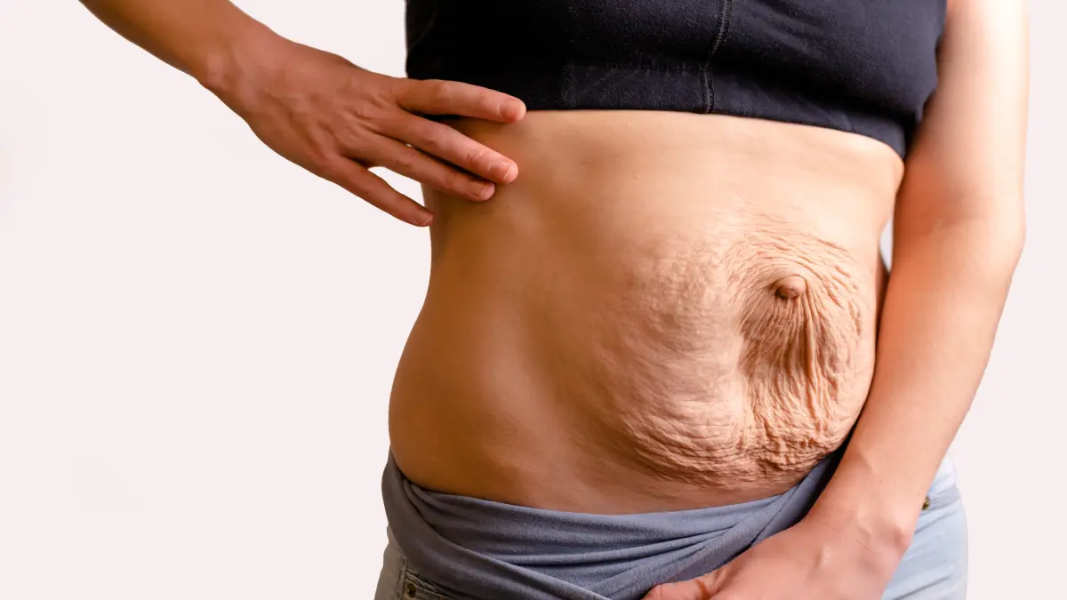 Das Bild zeigt eine Frau nach der Schwangerschaft mit sichtbarer Rektusdiastase und Nabelbruch.