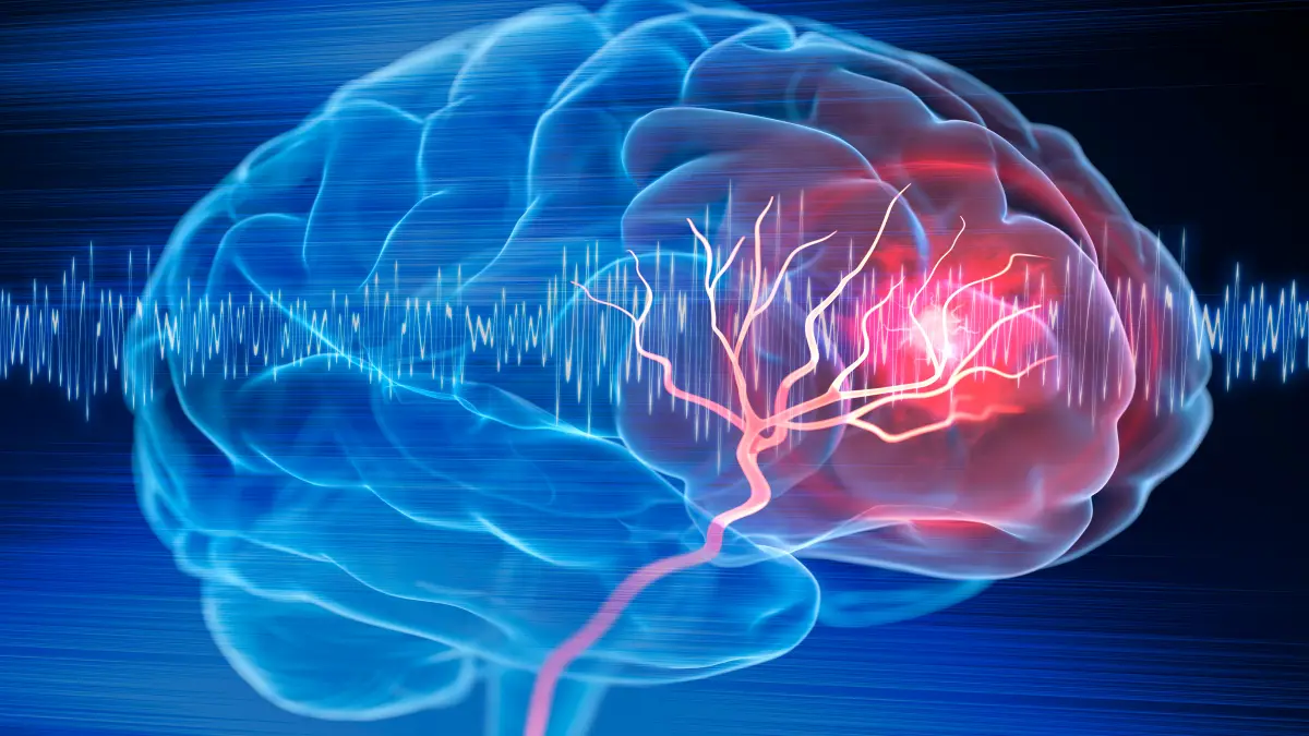 X- Ray illustration of brain stroke - 3d Illustration