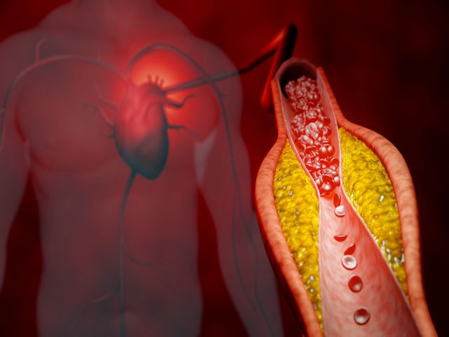 Darstellung von Arterienverkalkung mit Plaques und deren Einfluss auf die Herzgesundheit.