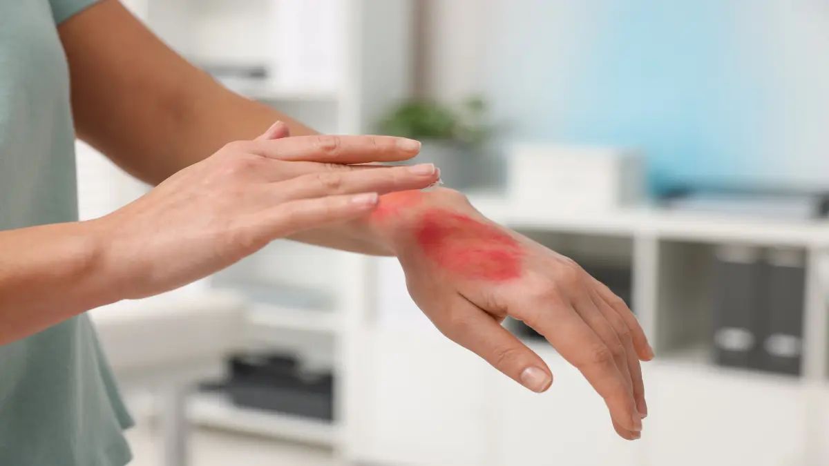 Gerötete Hand